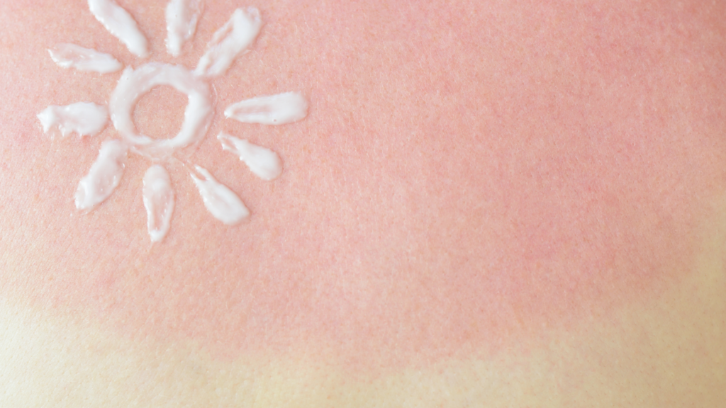 Sonnenbrand | Wenn die Haut brennt. Entstehung und Lösung von Sonnenbrand aus Sicht der klinischen PNI- kPNI-Akademie_ Bild verbrannte, rote Haut